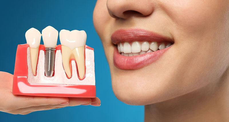 The image shows a woman holding a dental implant model, illustrating the implant post and crown. Her bright smile highlights the benefits of dental implants for a natural, restored look. The background contrasts the model, emphasizing the implant's features and the aesthetic improvement.