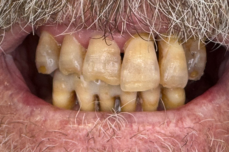 Carl had been struggling with severe periodontal disease for years, resulting in the loss of all his premolars and molars due to the chronic degradation of supporting bone caused by this condition.