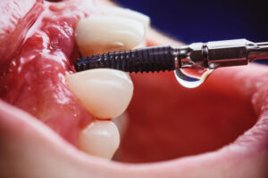 a single dental implant being placed into the mouth with a tool